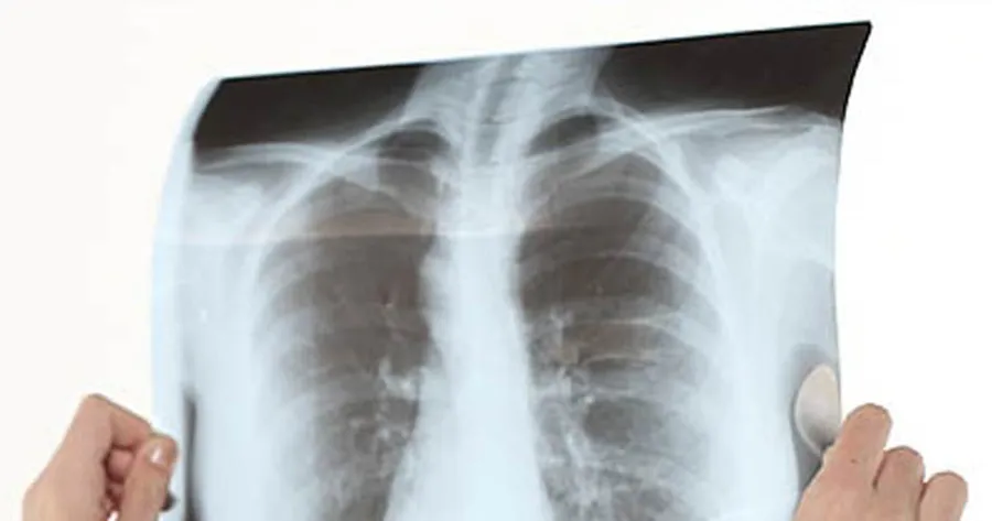 Is That Cough a Sign of COPD?
