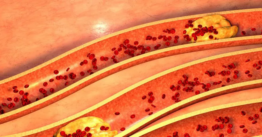 What’s the Difference Between Good and Bad Cholesterol?