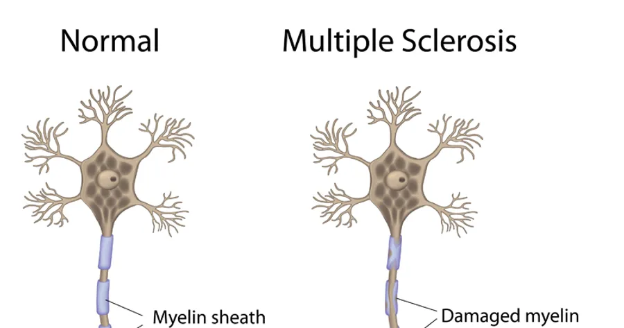 Types of Multiple Sclerosis: The Facts