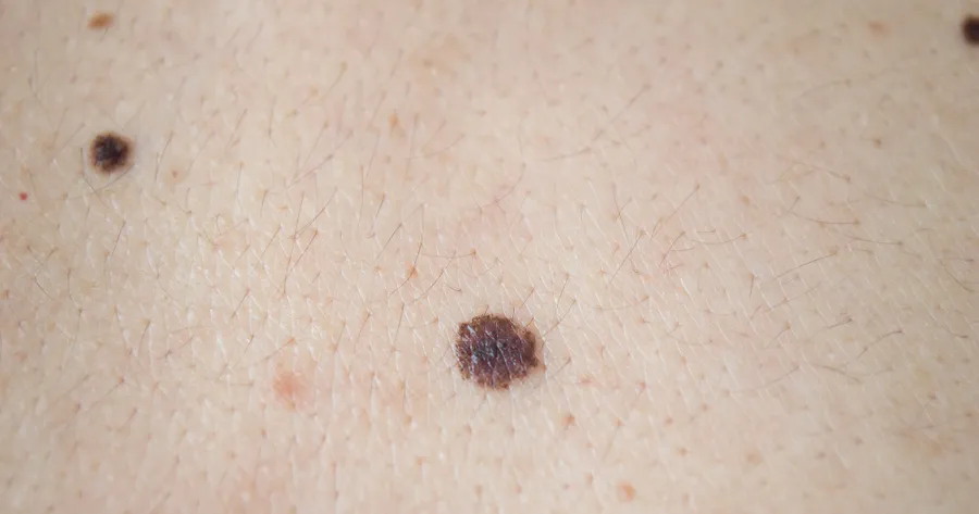 Metastatic Melanoma: What’s the Prognosis?