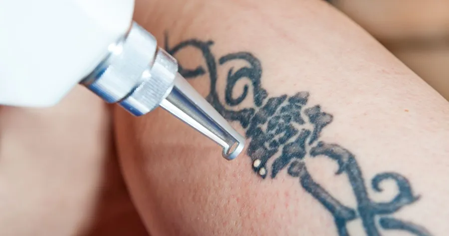 Everything You Need to Know About Laser Tattoo Removal