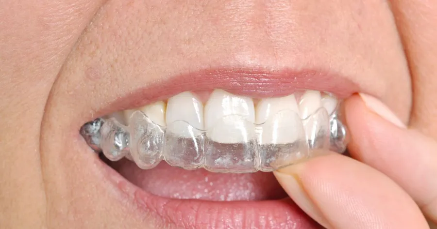 Invisalign: Is It Worth It?