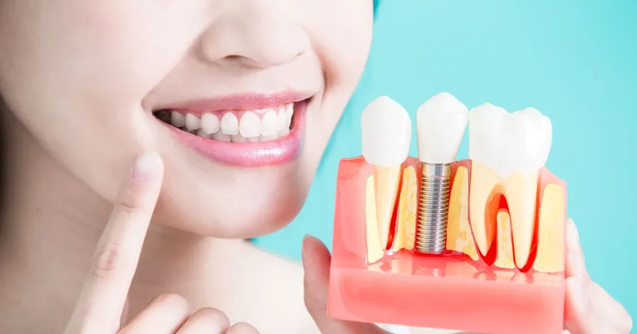 What You Need to Know About Dental Implants Costs