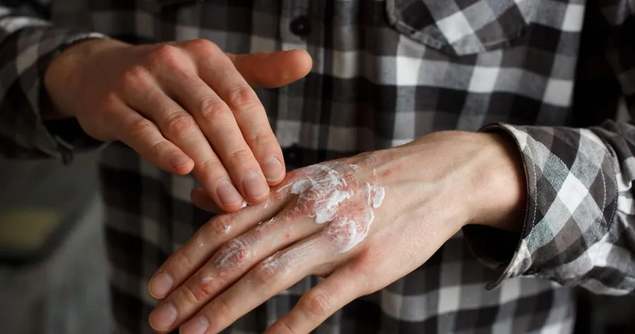 Everything You Need to Know About Psoriasis