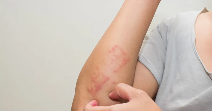 What Is Eczema?