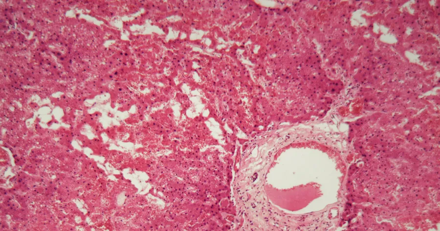 The Signs and Symptoms of Amyloidosis