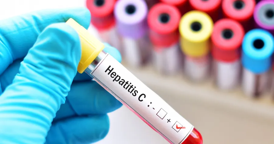 Signs, Symptoms, and Risk Factors of Hepatitis C