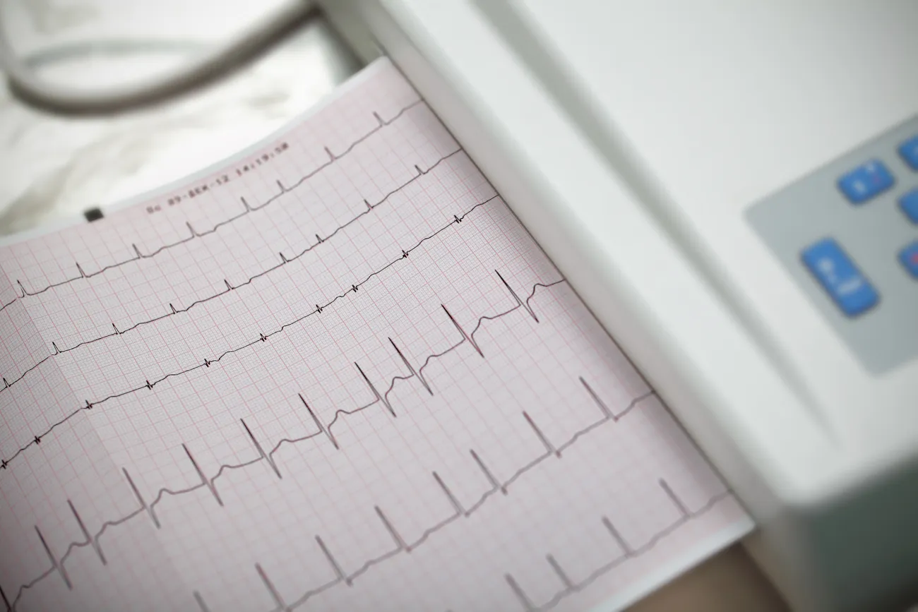 Understanding Atrial Fibrillation: Symptoms, Risks, and Management