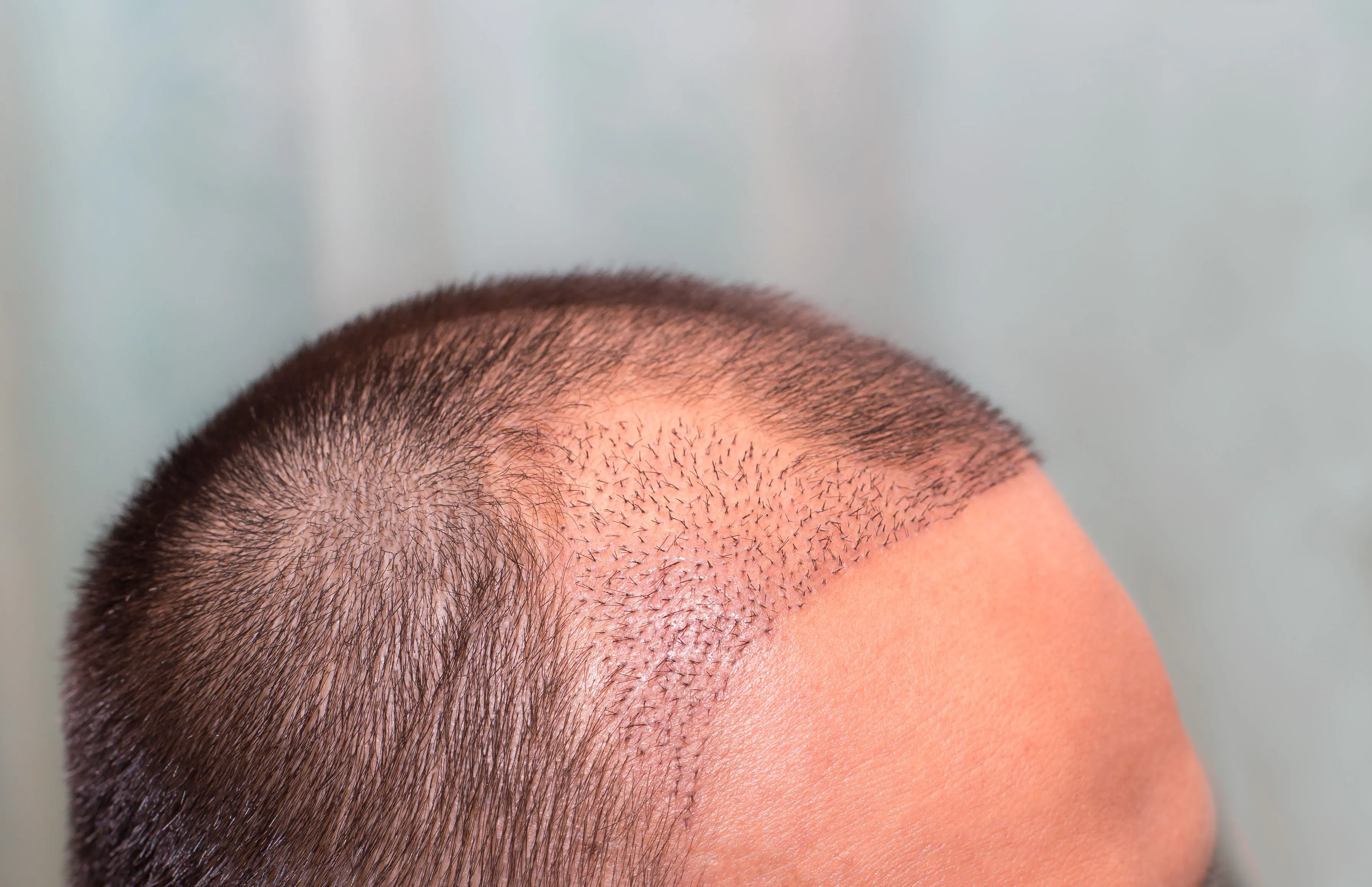 The Ultimate Guide to Hair Transplant Procedures: Costs and Locations Explained