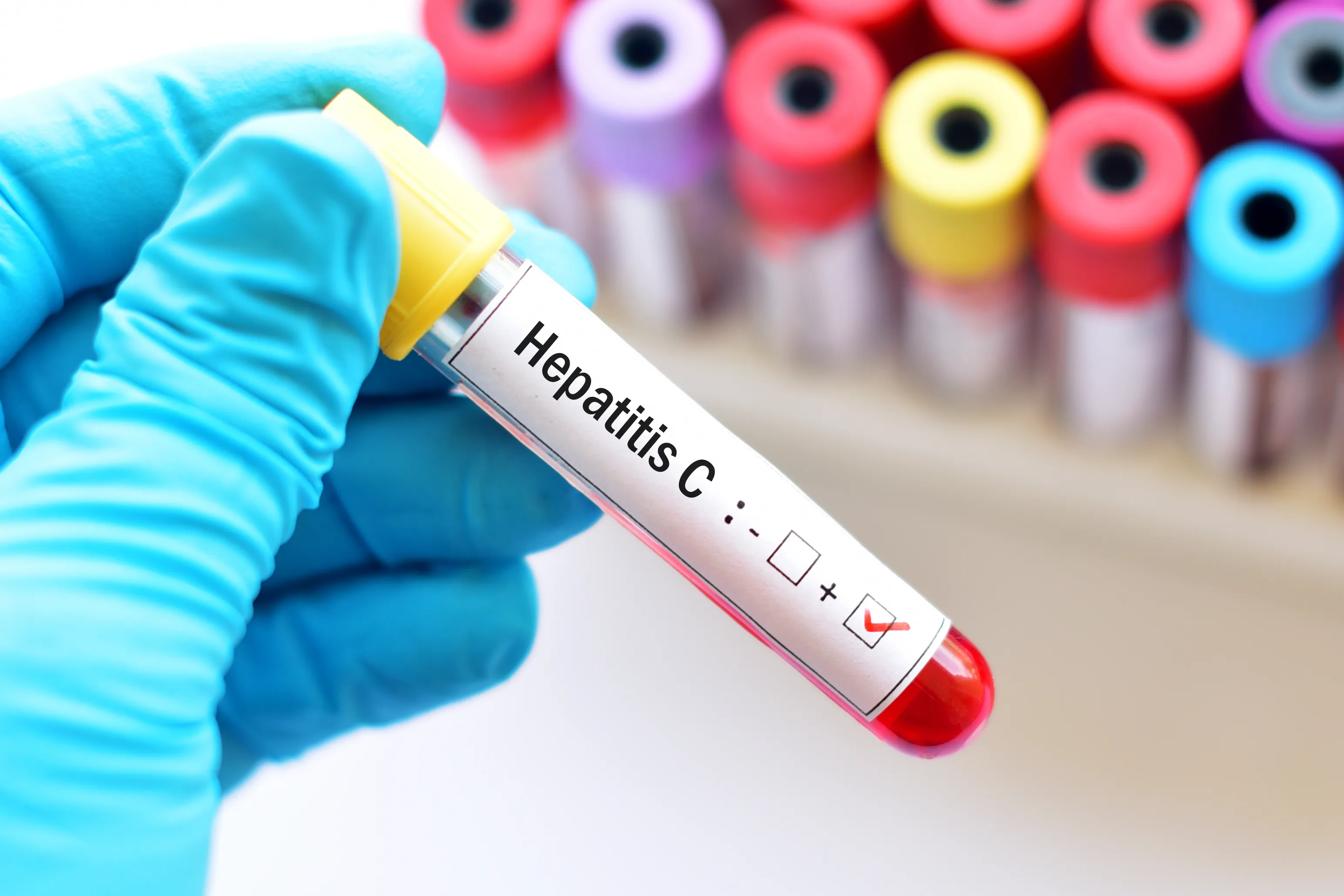 Everything You Should Know About Hepatitis C