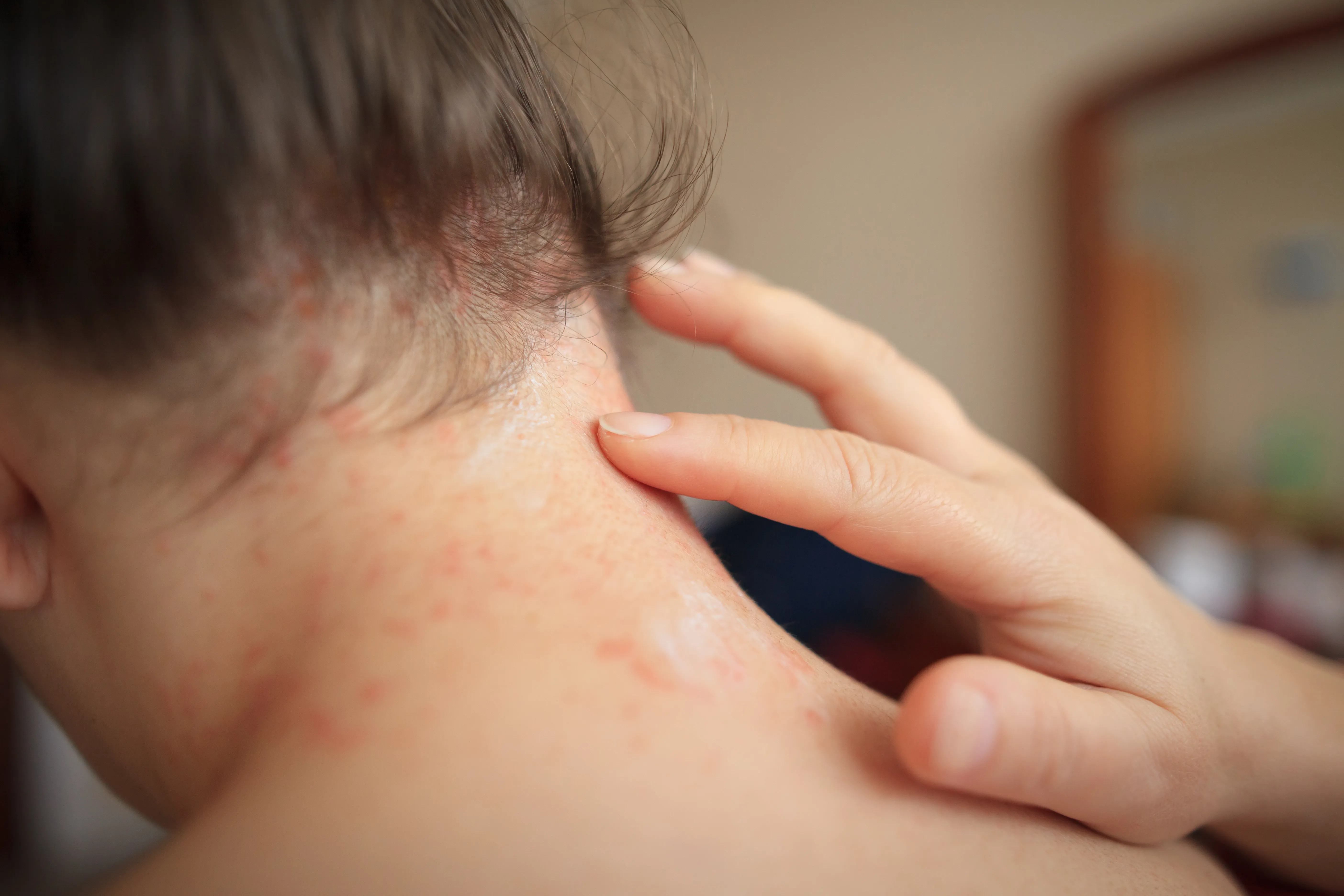 Early Signs of Eczema? Explore New Treatment Options