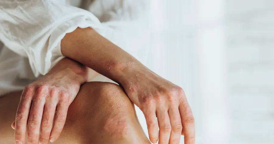 Psoriasis Treatments: Home Remedies and Medical Remedies