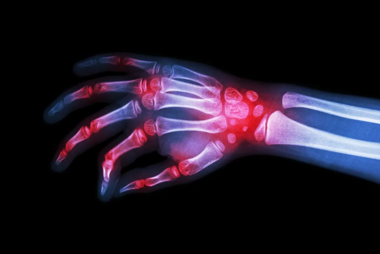 What Do I Need to Know About Rheumatoid Arthritis?