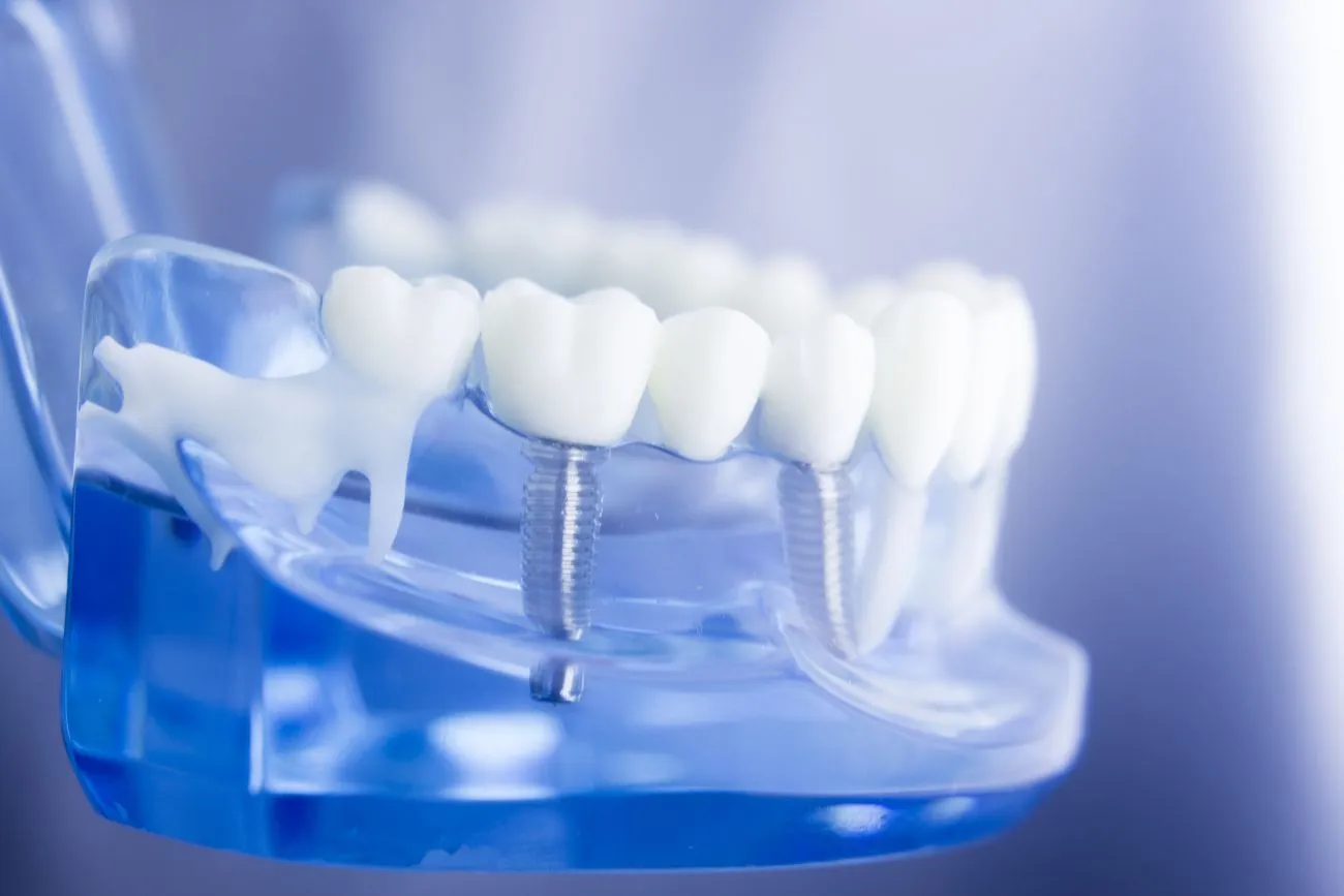 What Are the Most Popular Dental Implant Options Available Now?