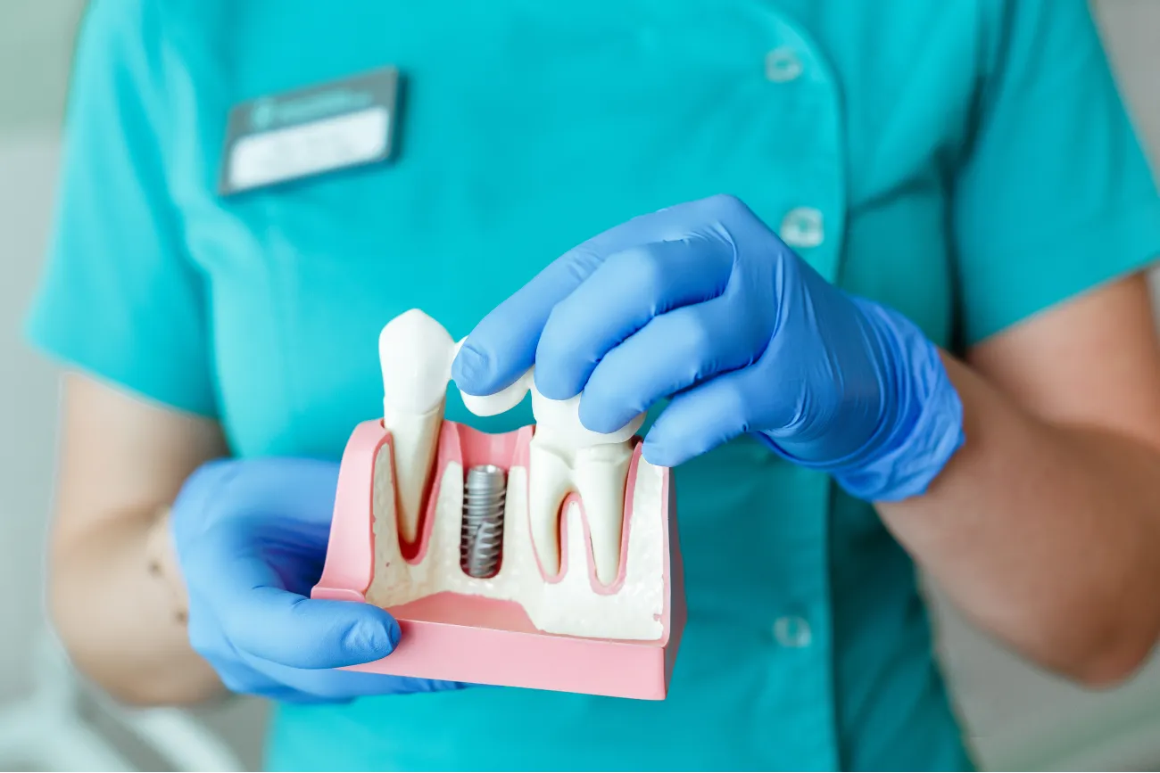 Is It Possible to Get Free Dental Implants?