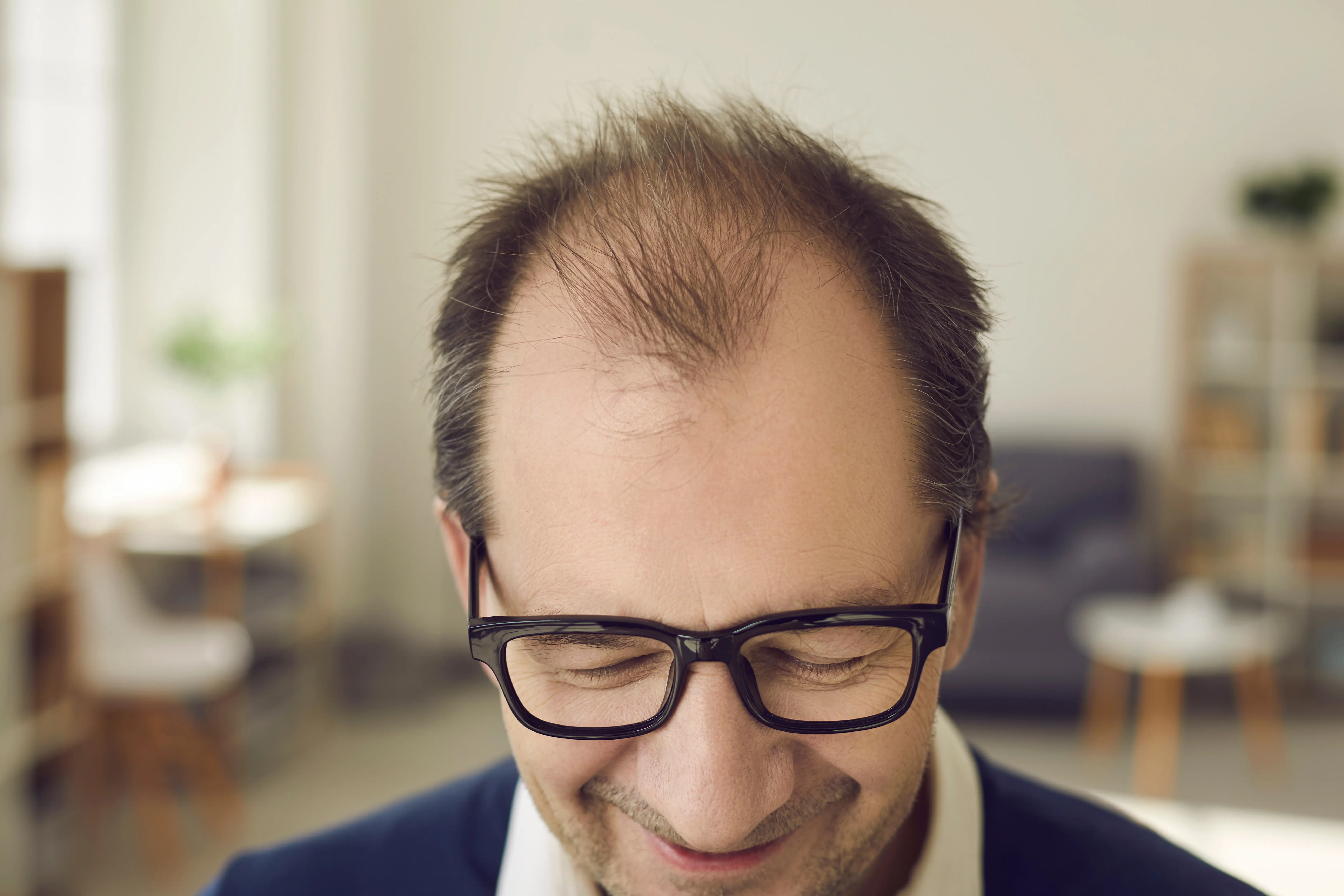 What You Can Expect From Hair Transplants In 2023 (Plus Costs of Popular Locations)