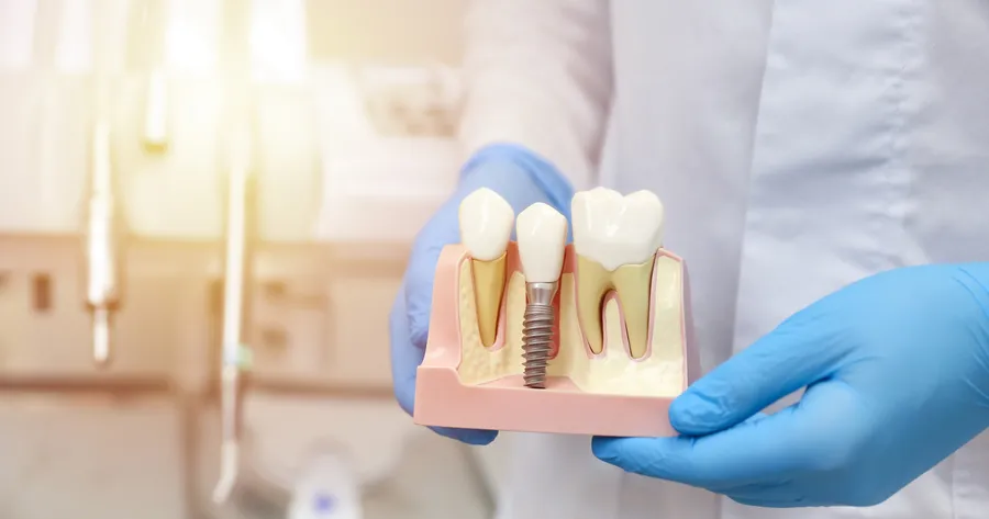 Here Is What You Should Pay For Dental Implants