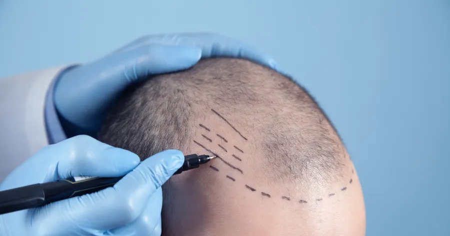 Choosing the Right Hair Transplant Surgeon: Tips and Tricks