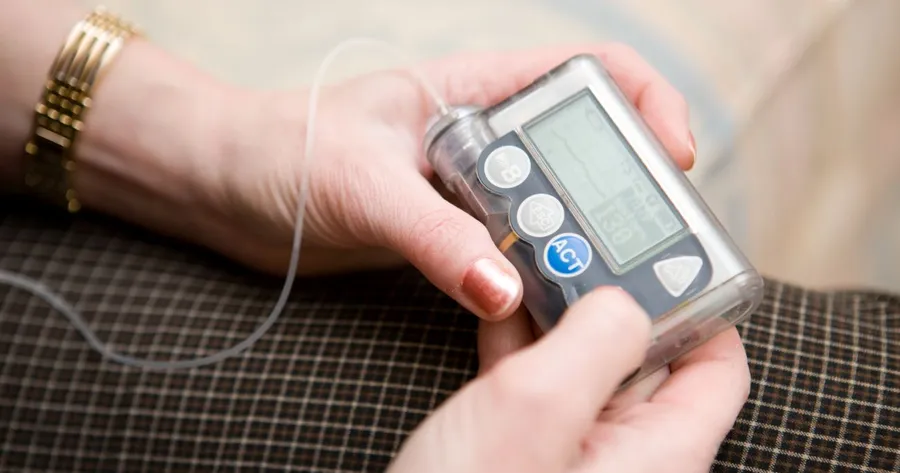 Insulin Pump Therapy for Type 2 Diabetes