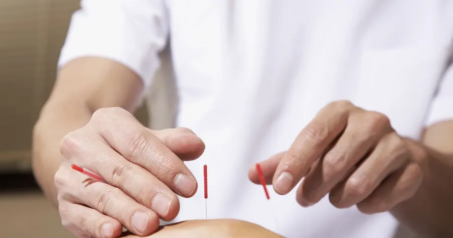 What to Expect with an Acupuncture Treatment