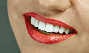 home-teeth-whitening