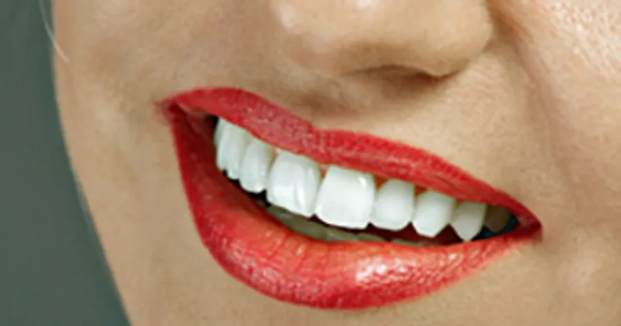 5 Things to Know About Home Teeth Whitening