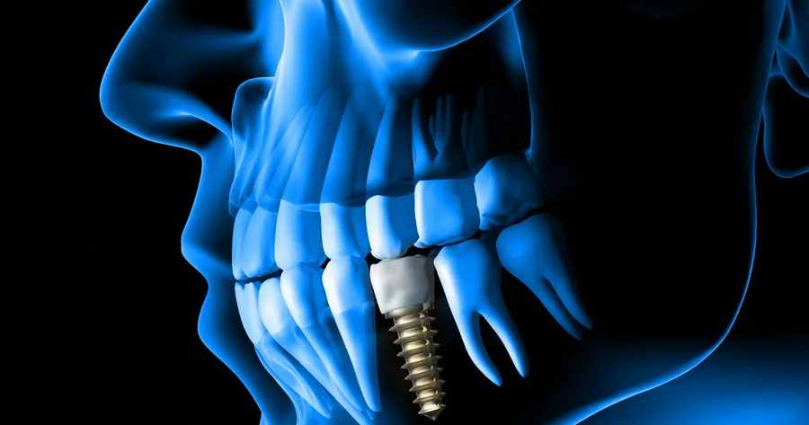 What to Expect When You’re Getting Dental Implants