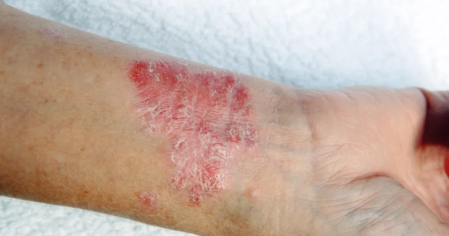 The Early Signs of Plaque Psoriasis