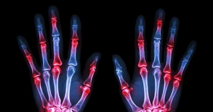 The Early Signs of Rheumatoid Arthritis