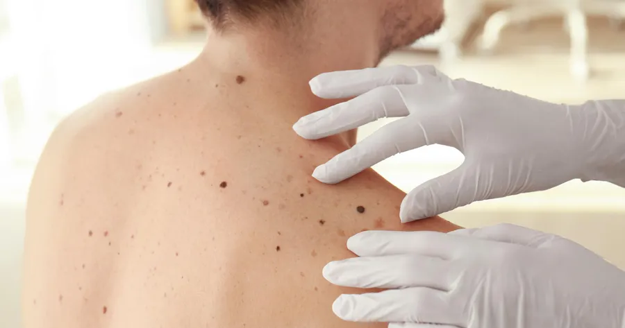 The Early Warning Signs of Melanoma