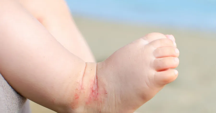 Understanding the Risk Factors, Symptoms, and Treatments of Eczema