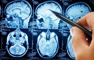 MRI scans of brain