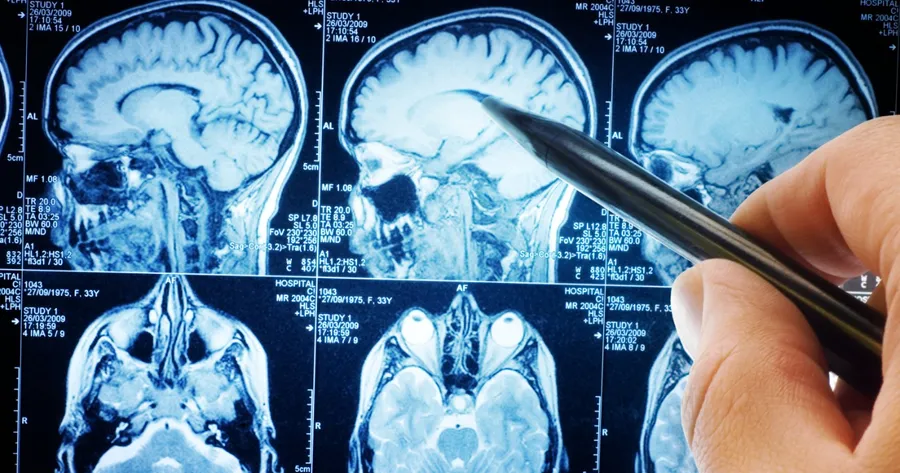 Early Warning Signs and Treatments of Brain Cancer