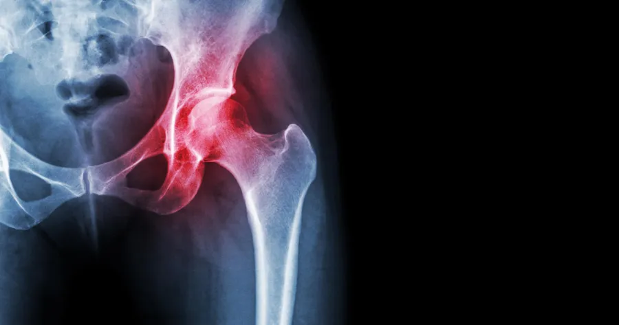 Ankylosing Spondylitis: Symptoms and Treatment Options