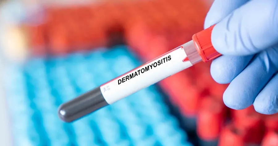 Dermatomyositis: Common Signs and Symptoms Unveiled