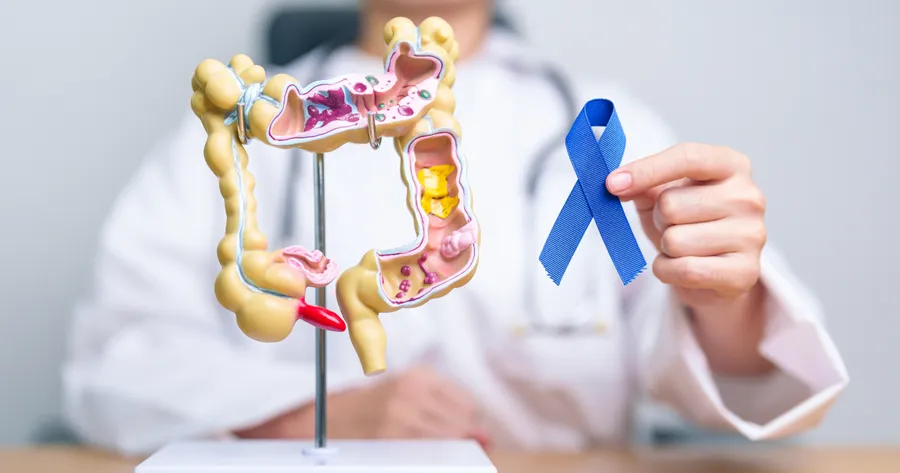 Colon Cancer: Prevention, Screening, and Early Detection