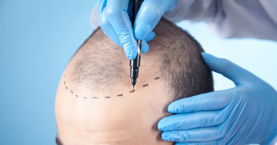 Hair Transplants: Regain Confidence with Natural-Looking Results