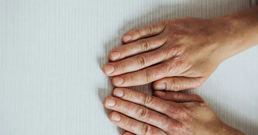 Psoriatic Arthritis: Affordable Relief is Within Reach