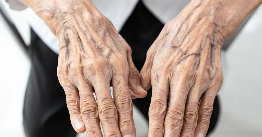 Why Seniors Shouldn’t Ignore These Stasis Dermatitis Signs