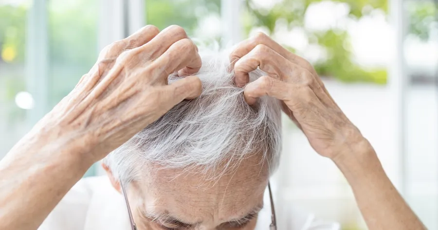 Seborrheic Dermatitis in Seniors: Symptoms, Risks, and Care Strategies