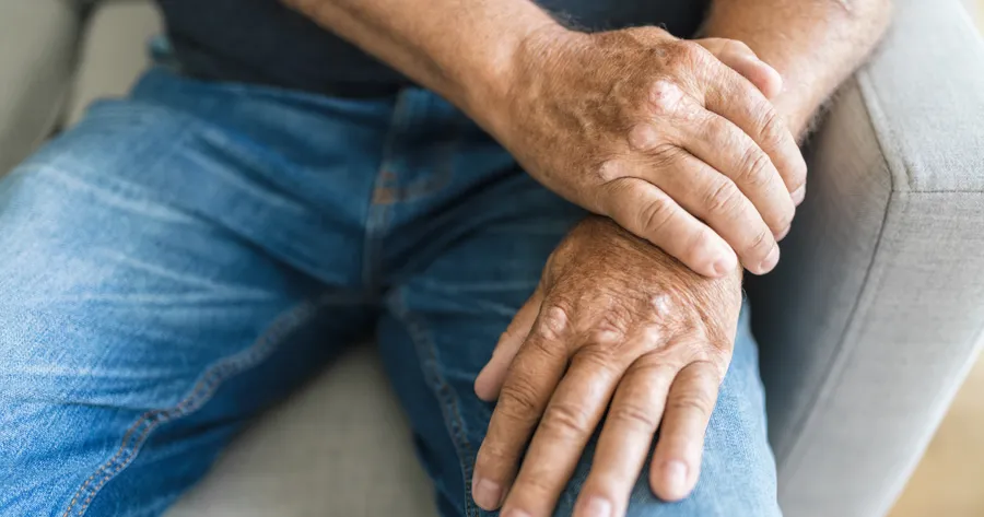 Understanding Psoriatic Arthritis: Symptoms, Causes, and Treatment Options