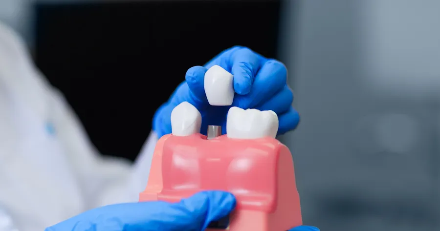 Affordable Dental Implants In Canada: Tips On Finding The Best Deals