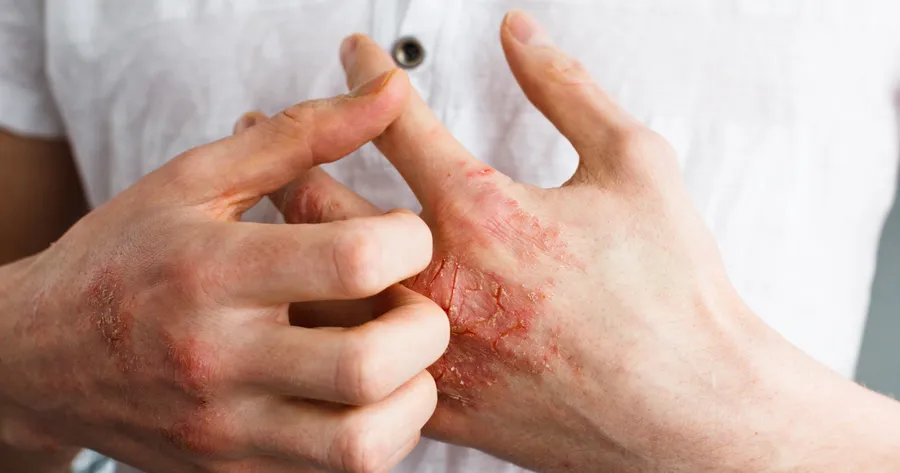 A Guide to Atopic Dermatitis: Signs and Treatment Strategies