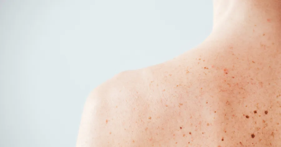 Understanding Melanoma: Signs, Symptoms, and Risk Factors You Should Know