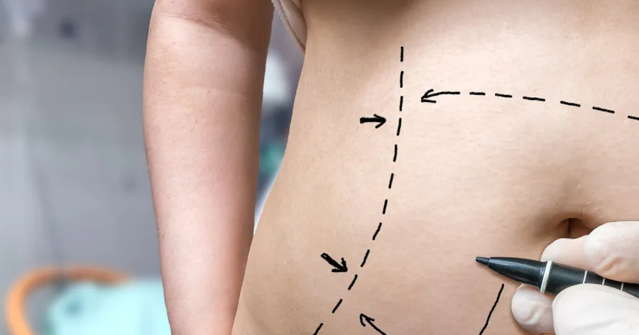 How to Get a “Tummy Tuck” for Less Near You