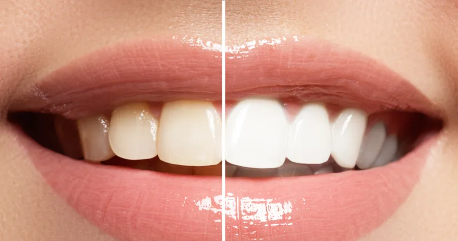 How to Save Big on Professional Teeth Whitening