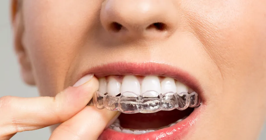 Smile Bright on a Budget: How to Secure Affordable Invisible Aligners (Invisalign)