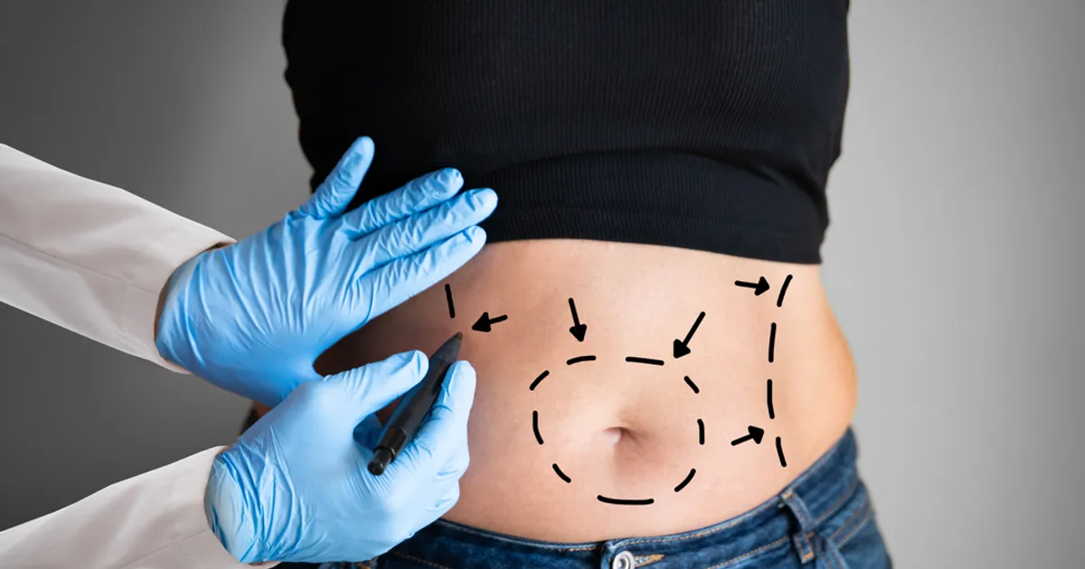 Belly Fat Removal Surgery How Much Does It Cost? Topic Insight