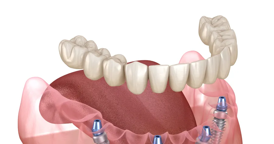 Brighten Your Golden Years: Same Day Dental Implants for Seniors