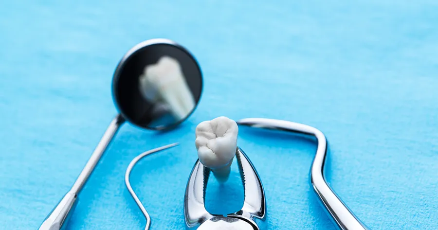 A Penny Saver’s Guide to Wisdom Tooth Extraction: Affordable Options Explored